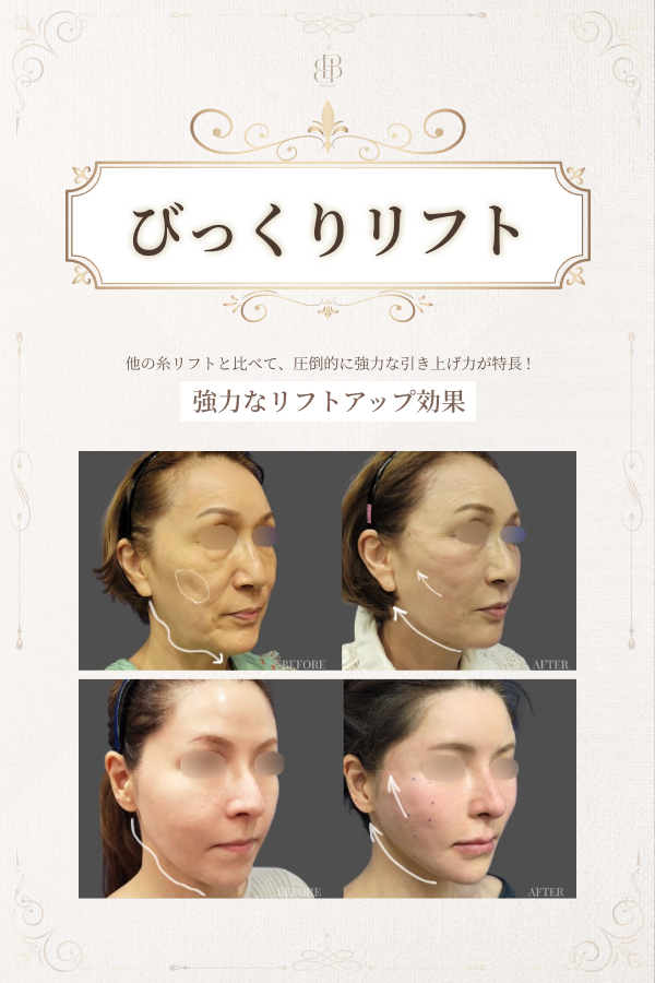 びっくりリフト