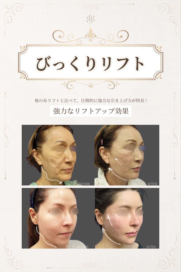 びっくりリフト