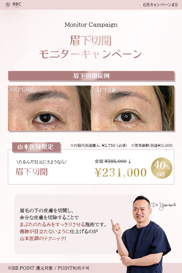 眉下切開